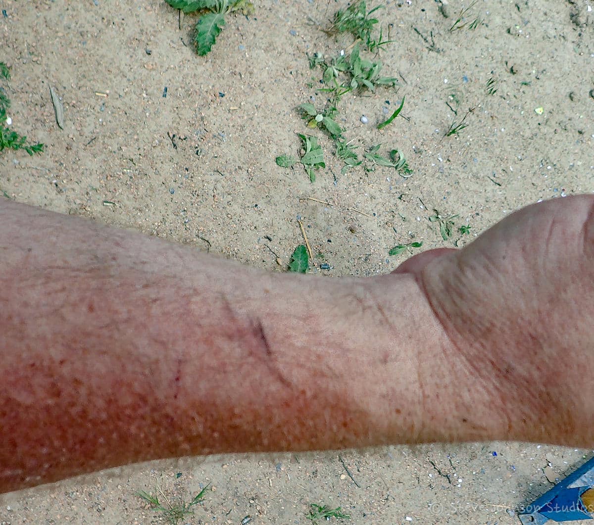DP-12 Bruise and Cuts